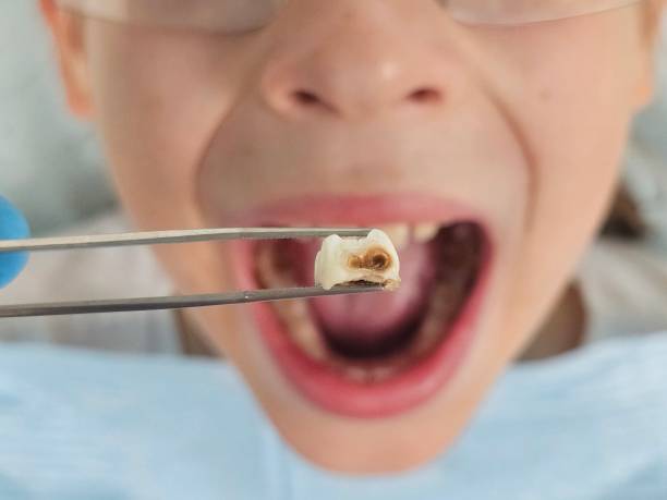 Best Emergency Wisdom Teeth Removal in Lagunitas Forest Knolls, CA